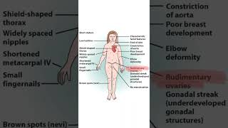 Turner's Syndrome | Chromosomal Disorder #shorts #neet #biology