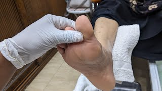 Pedicure Huge Extremely dry skin removal/ easily scraps Skins