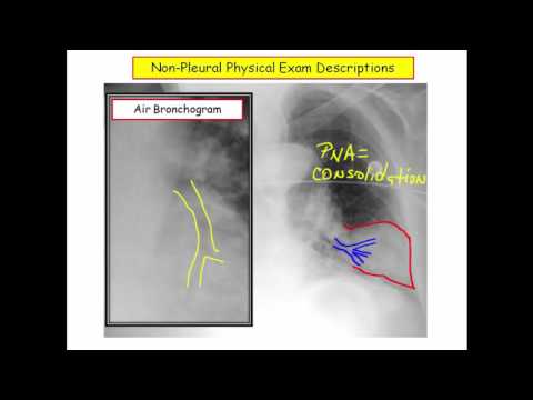 12DaysinMarch, Pleural Disorders for USMLE Step One