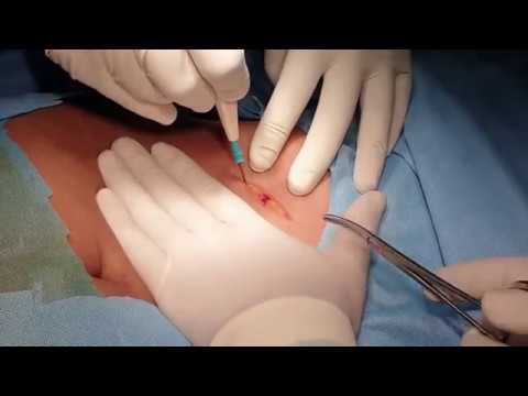 Open cholecystectomy : Learn simple and safe technique