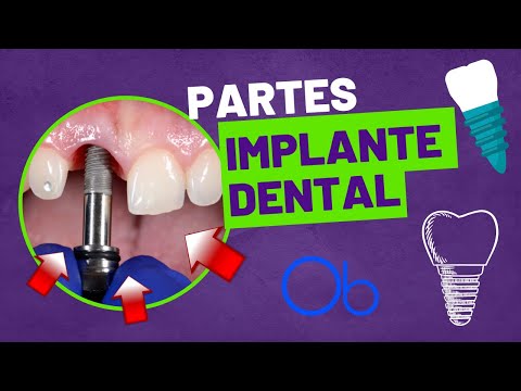 PARTES DEL IMPLANTE DENTAL