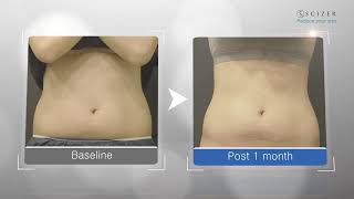 CLASSYS SCIZER Casos Clínicos EN