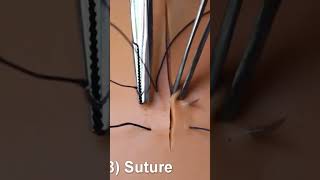 Download lagu 188.Figure of 8 suture #technique of suturing #dental procedure  #dentist #surgeryeducation #stitch mp3 Download lagu 188.Figure of 8 suture #technique of suturing #dental procedure  #dentist #surgeryeducation #stitch mp3