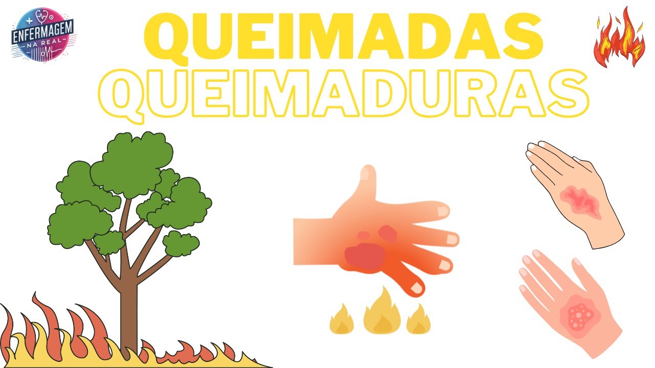 Queimadas, Incêndio e Queimaduras: Causas, Consequências e Como se Proteger