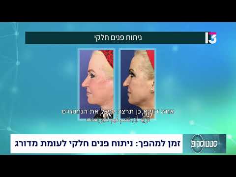  ניתוח פנים חלקי לעומת מדורג