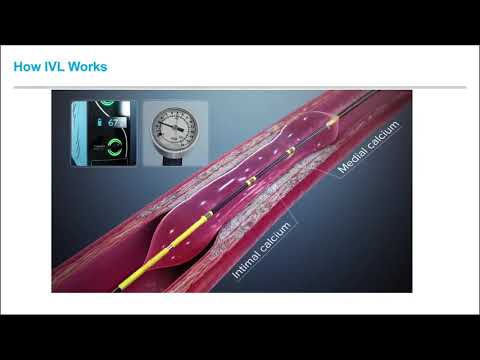 Intravascular Lithotripsy and its Application in Iliac Disease with Dr. Ehrin J. Armstrong