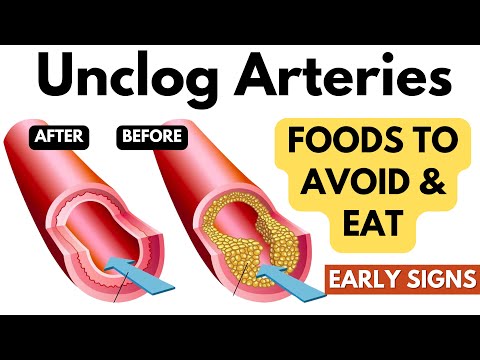 Clear Blocked Arteries | Early Signs and Symptoms | Foods to Avoid | Foods To Eat Clogged Arteries