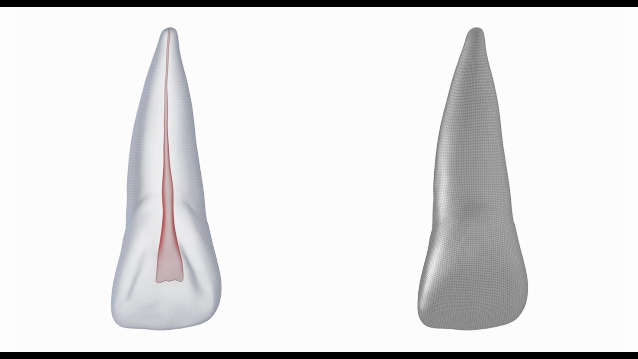 Dente incisivo centrale superiore sinistro umano con cavit&agrave; pulpare Modello 3D