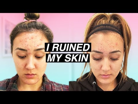 MY SKIN STORY: How I Ruined My Skin (And Fixed It) Video