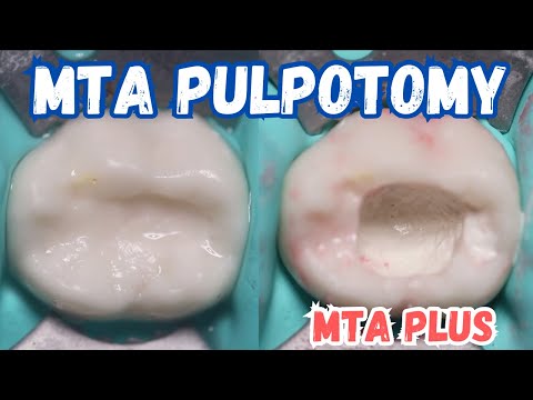 MTA Pulpotomy - Step By Step
