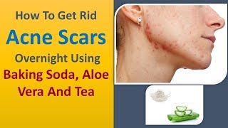 How To Get Rid Acne Scars Overnight - Using Baking Soda, Aloe Vera And Tea Remedies -