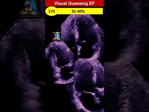 Handy Visual Guessing Ejection Fraction