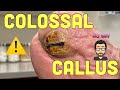 EXTREMELY BIG FOOT CALLUS