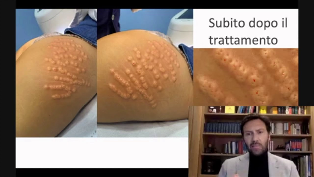 Eliminare le smagliature e le cicatrici acne con Enerjet 2.0