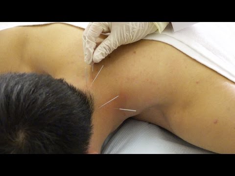 Acupuncture Sujok Needle