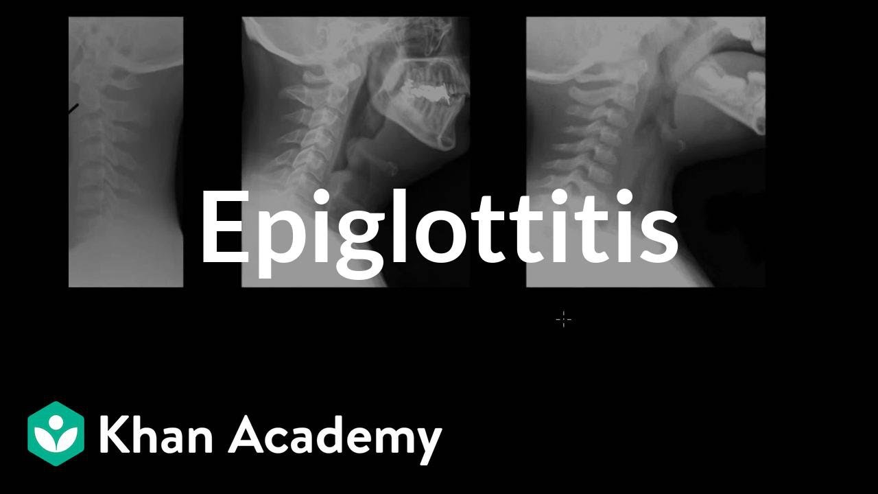 Epiglottitis diagnosis and treatment | Respiratory system diseases | NCLEX-RN | Khan Academy - YouTube