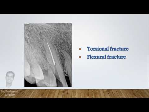 Instrument Fracture In Rotary Endodontics - How To Prevent It?