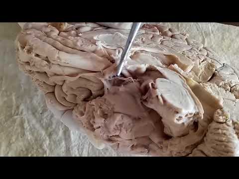 NEUROANATOMY - THIRD VENTRICLE, THALAMUS, HYPOTHALAMUS AND CORPUS CALLOSUM - BY DR MITESH DAVE