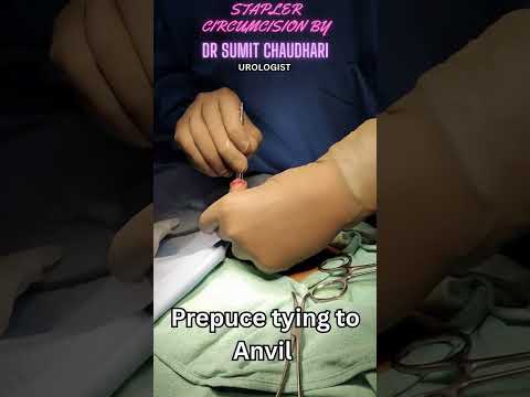 Stapler Circumcision | Dr. Sumit Chaudhari 