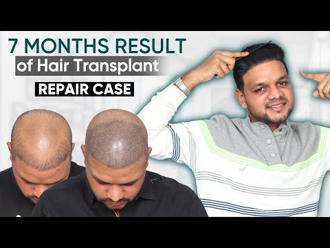 Hair Transplant in Istanbul | Repair Case