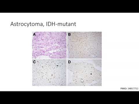 CNS Neurosurgery 100: Glioma Biology