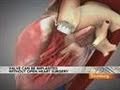 Edwards 30 000 Heart Valve May Double Revenue Lure Bid Video