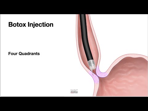 HCC 1475-25  Botox injection