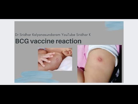What is BCG reaction? What can parents expect at site of the BCG ...