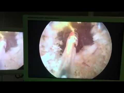 Analisi della puntura della prostata Escrescenze massaggio prostatico uomini