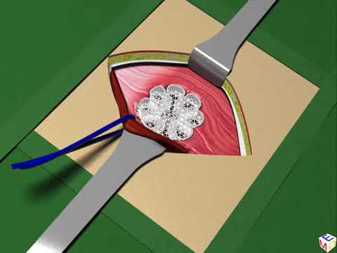 Direct inguinal hernia 3D