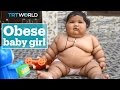 Obese Baby Leaves Doctors Confused