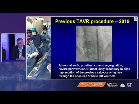 LIVE CASE 1- VALVE-IN-VALVE