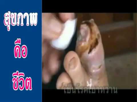 ยาเสพติดและโรคสะเก็ดเงิน novopassit น้ำมันยี่หร่าโรคสะเก็ดเงิน
