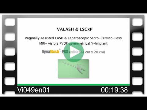 DynaMesh®-PRS visible 04 cm x 20 cm - OR-Video: Vaginally Assisted LASH & Lap Sacro-Cervico-Pexy