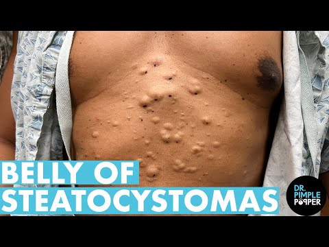 A Belly Full Of Steatocystomas! Dr Pimple Popper Mines a Patient's Stomach - Part 1