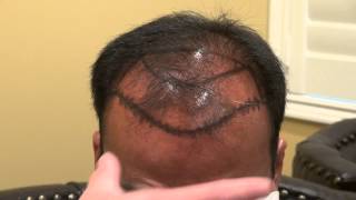 preview picture of video 'Man Bald Hair Loss Treatment Dr. Diep www.mhtaclinic.com Los Gatos Near San Jose Califiornia'