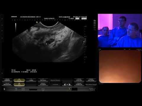Unclear pancreatic head radiofrequency