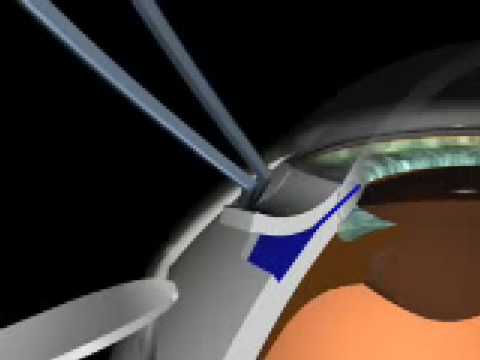 Glaucoma Surgery - Prof. O. Findl, Ophthalmologist Vienna