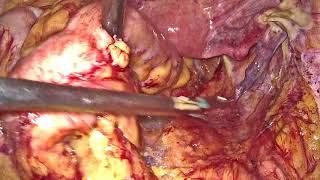 Download Lagu Laparoscopic Repair For Rectal Prolapse with Intussusception Thumbnail