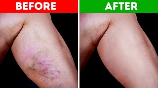 9 Natural Ways to Get Rid of Varicose Veins and Increase Blood Flow