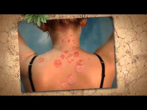 Dermatite di atopic su un trattamento di unguento di faccia Akrustat per capelli
