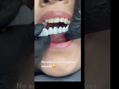 No other cosmetic appliance does this ! Snap-on Smile ❤️