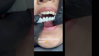 No other cosmetic appliance does this ! Snap-on Smile ❤️