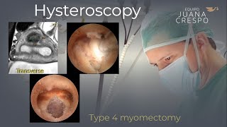 Type 4 hysteroscopic myomectomy