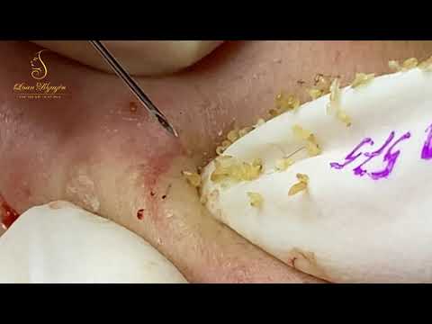 Loan Nguyen Acne Treatment (#125)