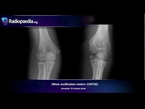 Centres d'ossification du coude (CRITOE) - tutoriel vidéo sur la radiologie