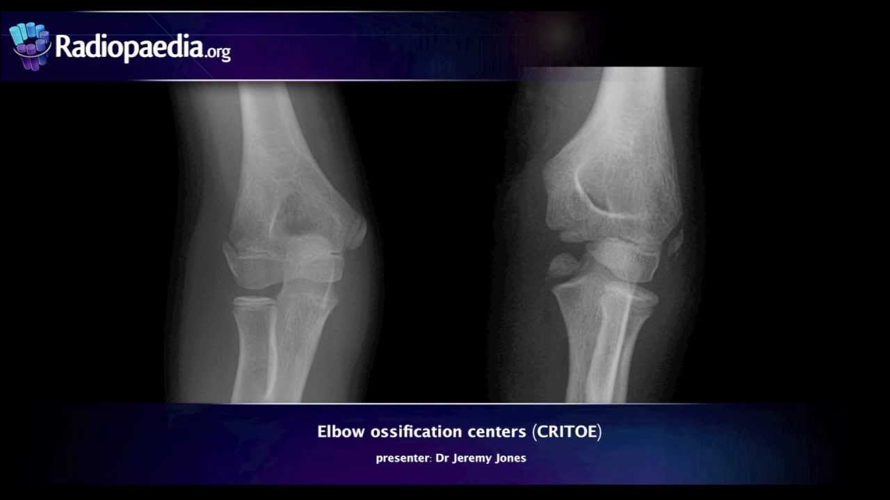 Elbow ossification centers (CRITOE) - radiology video tutorial