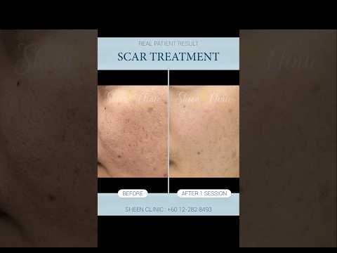 Restylane Skin Booster for Rolling Acne Scars | Plump, Heal & Glow