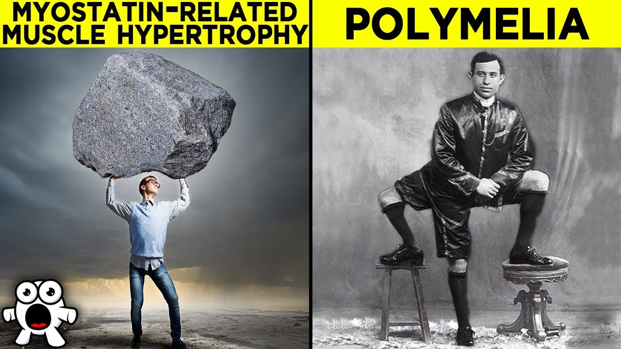 Rare Diseases That Give People Superhero-Like Abilities