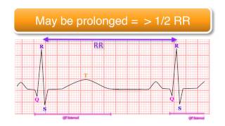 ECG basics 10/10 - The QT Interval